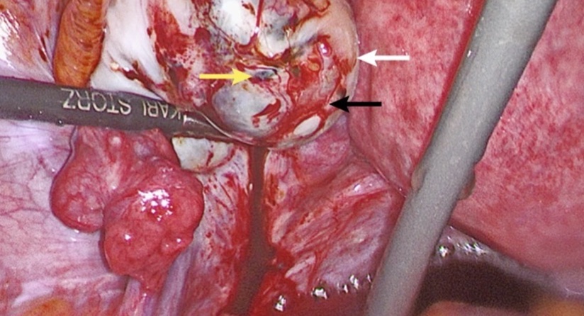 Left ovary with draining endometriotic (chocolate) cyst (white arrow; panel c). Superficial red lesions (black arrow) and black lesions (yellow arrow) are also present.