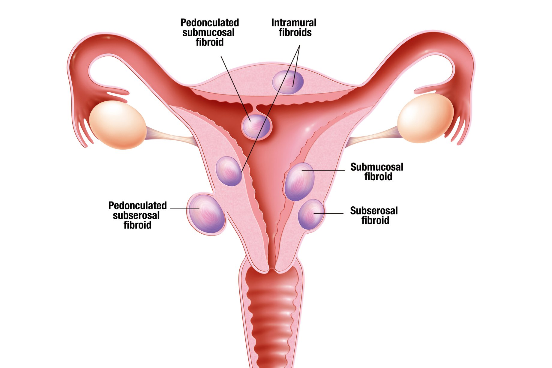 Diagram of the locations of uterine fibroids. Adapted from Mayo Foundation for medical education.
